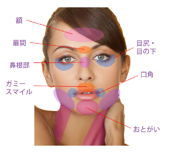 ボトックス
