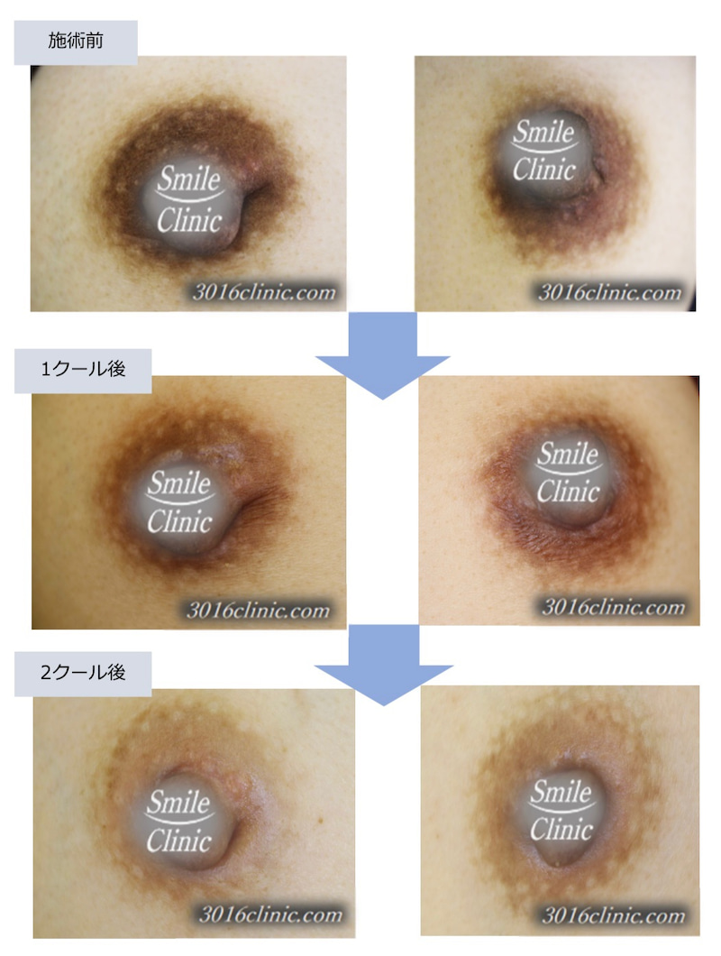 乳首 黒ずみ