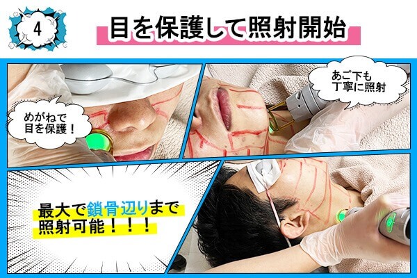 メンズリゼのヒゲ脱毛フロー4