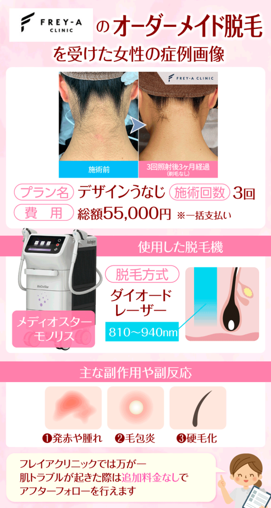 フレイアクリニックでオーダーメイド脱毛を受けた女性の症例画像と使用した脱毛機の詳細