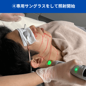 メンズリゼのヒゲ脱毛ステップ4