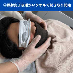 メンズリゼのヒゲ脱毛ステップ5