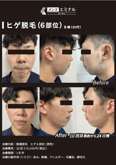 エミナルクリニックメンズのヒゲ脱毛6回の症例写真