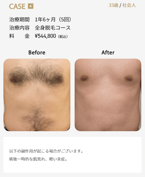 ゴリラクリニックで全身脱毛5回施術した症例画像