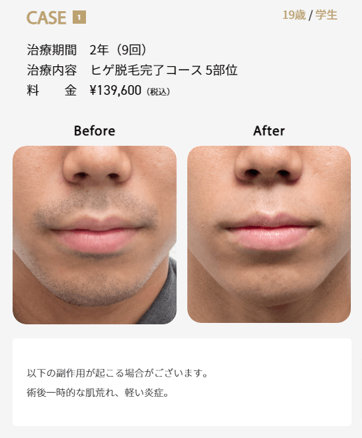 ゴリラクリニックでヒゲ脱毛5部位を9回施術した症例画像