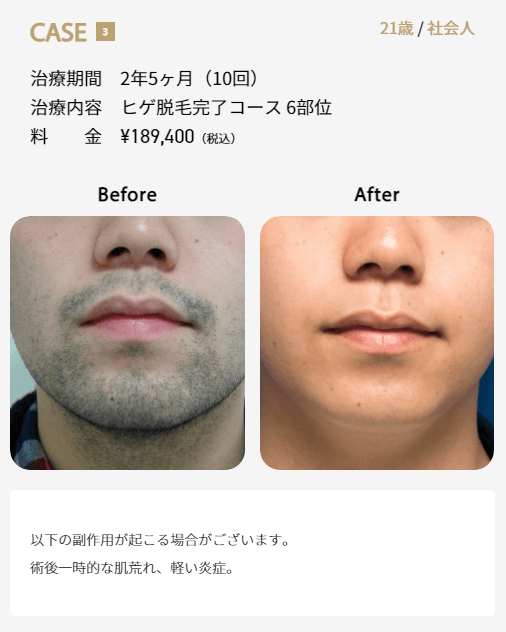 ゴリラクリニックでヒゲ脱毛6部位を10回施術した症例画像