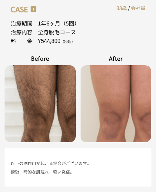 ゴリラクリニックで全身脱毛を5回施術した症例画像