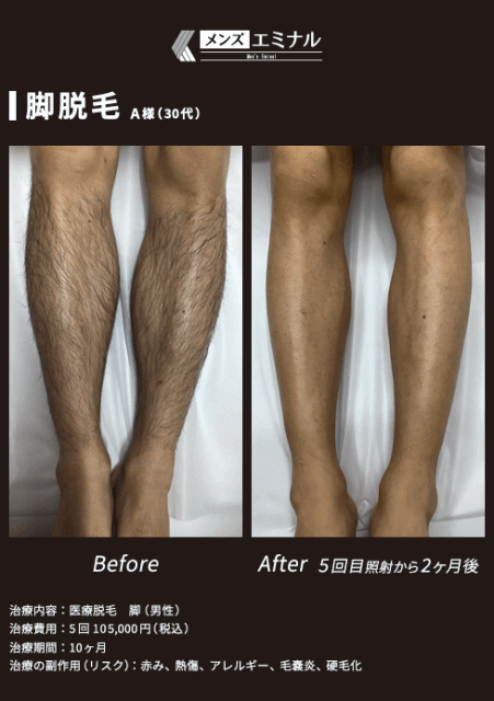 エミナルクリニックメンズの脚脱毛5回の症例写真