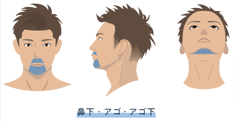 レジーナクリニックオムヒゲ脱毛3部位