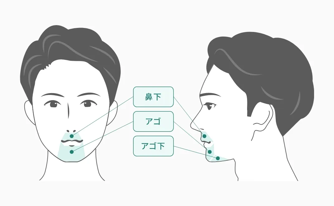 フレイアクリニックのヒゲ脱毛（3部位）の箇所を示した画像