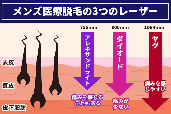 医療脱毛メンズのレーザーの種類