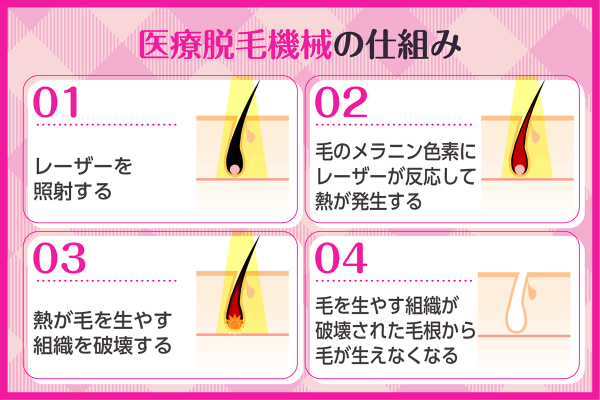 医療脱毛の機械の仕組み