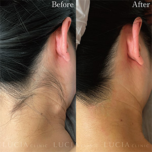ルシアクリニックでうなじの医療脱毛した女性の右側から撮影した際の症例画像