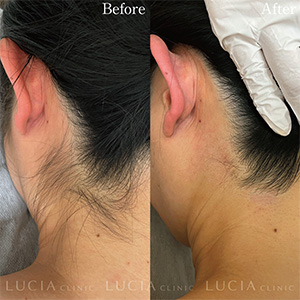 ルシアクリニックでうなじの医療脱毛した女性の左側から撮影した際の症例画像