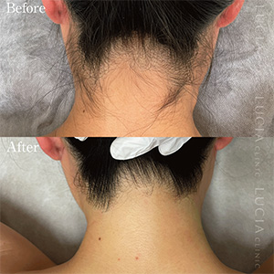 ルシアクリニックでうなじの医療脱毛した女性の背面からの症例画像