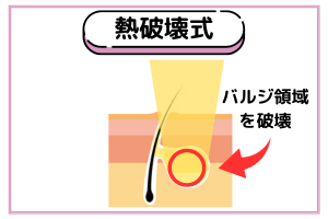 熱破壊式脱毛機はバルジ領域を破壊する
