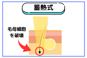 蓄熱式脱毛機は毛母細胞を破壊