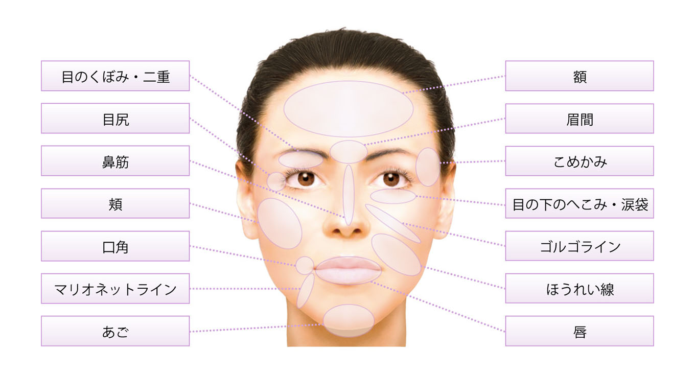 ヒアルロン酸の注入部位