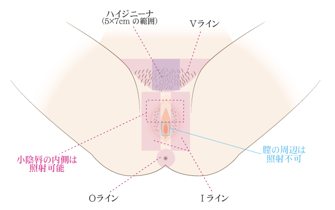 脱毛部位