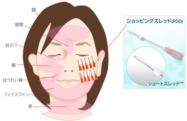 ショッピングスレッド（PDO）の特徴