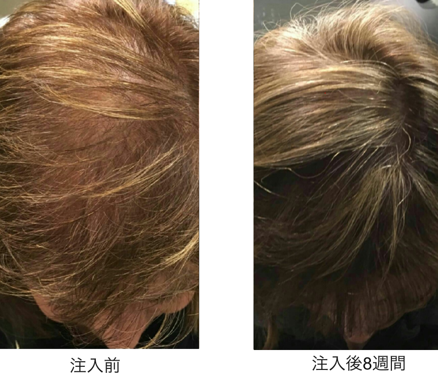 DR.CYJ ヘアフィラー - 麗ビューティー皮フ科クリニック | Rei Beauty Dermatology Clinic