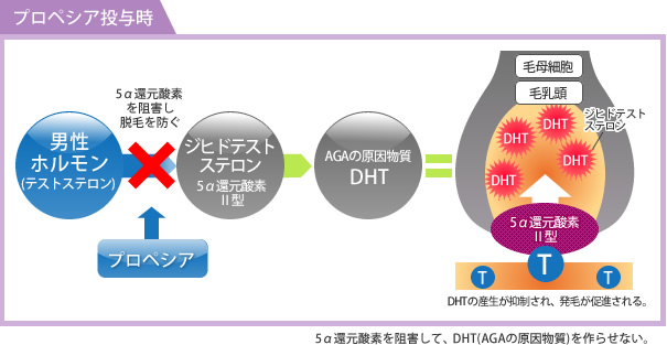 プロペシア(男性型脱毛症治療)