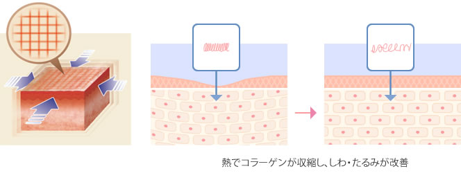 イントラジェン・イントラジェン アイの特徴