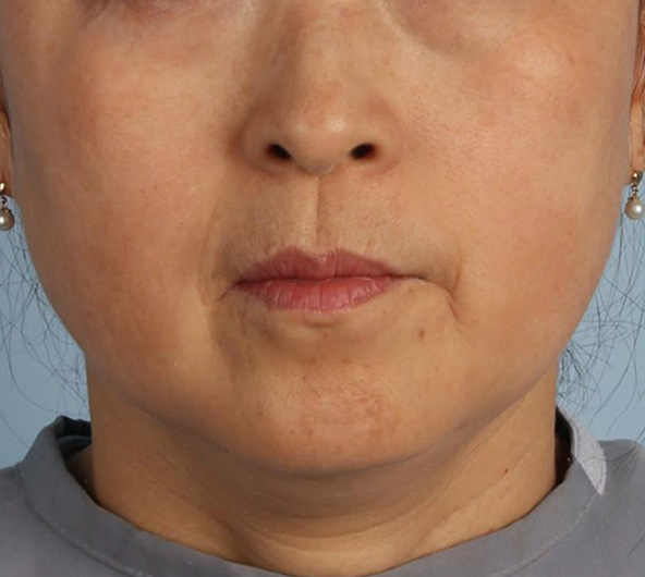 <p>1回治療<span>1</span>ヶ月後</p>
