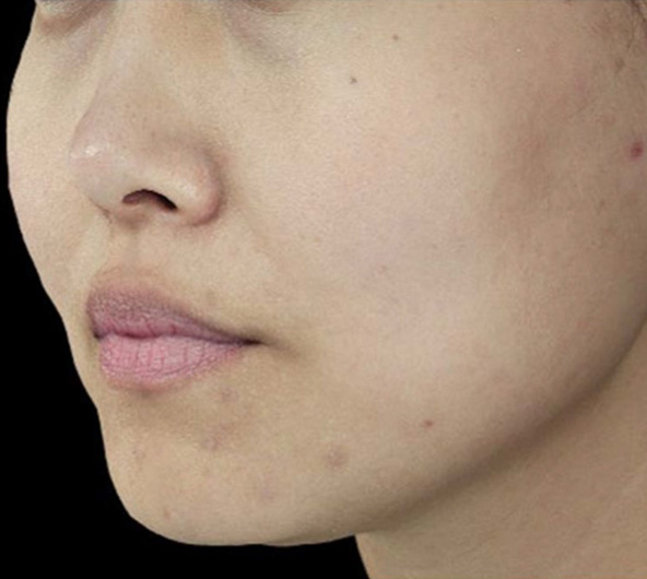 <p>1回治療<span>3</span>ヶ月後</p>
